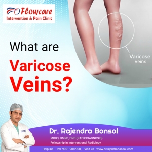 What are the Varicose Veins